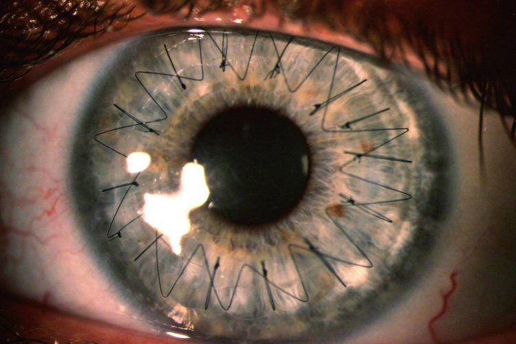 CORNEAL TRANSPLANT